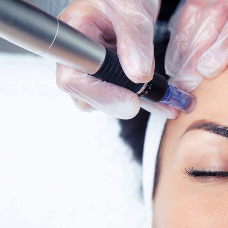 Morpheus8 treatment Hassocks from Lipo Sculpt - Book in today!
